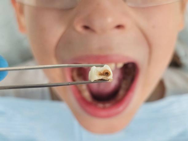 Best Emergency Root Canal Treatment in University Of Pittsburgh Johnstown, PA